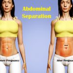 abdominal-separation-1